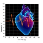 heart-rate-variability-post-stroke:-feasibility-study