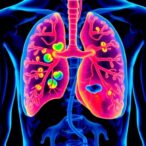 image-guided-radiotherapy-shows-promise-for-liver-cancer