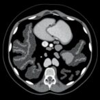 dual-time-point-pet/ct-enhances-colorectal-cancer-diagnosis