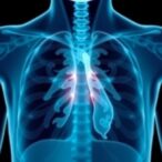 artificial-intelligence-enables-lung-cancer-detection-at-gp-clinics-four-months-sooner