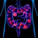 prmt5-expression-predicts-colon-cancer-chemotherapy-success