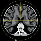 cnn-automates-ct-scoring-for-sinus-imaging
