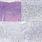 early-immune-evasion-detected-in-hpv-linked-pre-cancer-lesions-of-the-anogenital-region