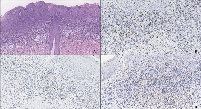 early-immune-evasion-detected-in-hpv-linked-pre-cancer-lesions-of-the-anogenital-region