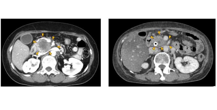 genetic-tool-enhances-treatment-strategies-for-pancreatic-cancer