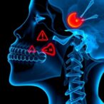 nasopharyngeal-necrosis-after-radiation:-risks-revealed