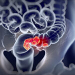 the-oncomicrobe-in-the-room:-surprise-antimicrobial-agent-targets-f.-nucleatum
