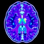 needle-biopsies-enable-multimodal-data-in-glioblastoma