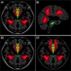 sex-differences-in-newborn-piglet-brain-cell-death