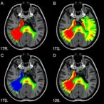 dual-region-mri-enhances-breast-cancer-risk-prediction