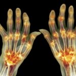 gut-microbiome-linked-to-rheumatoid-arthritis-through-reprogrammed-t-helper-cells