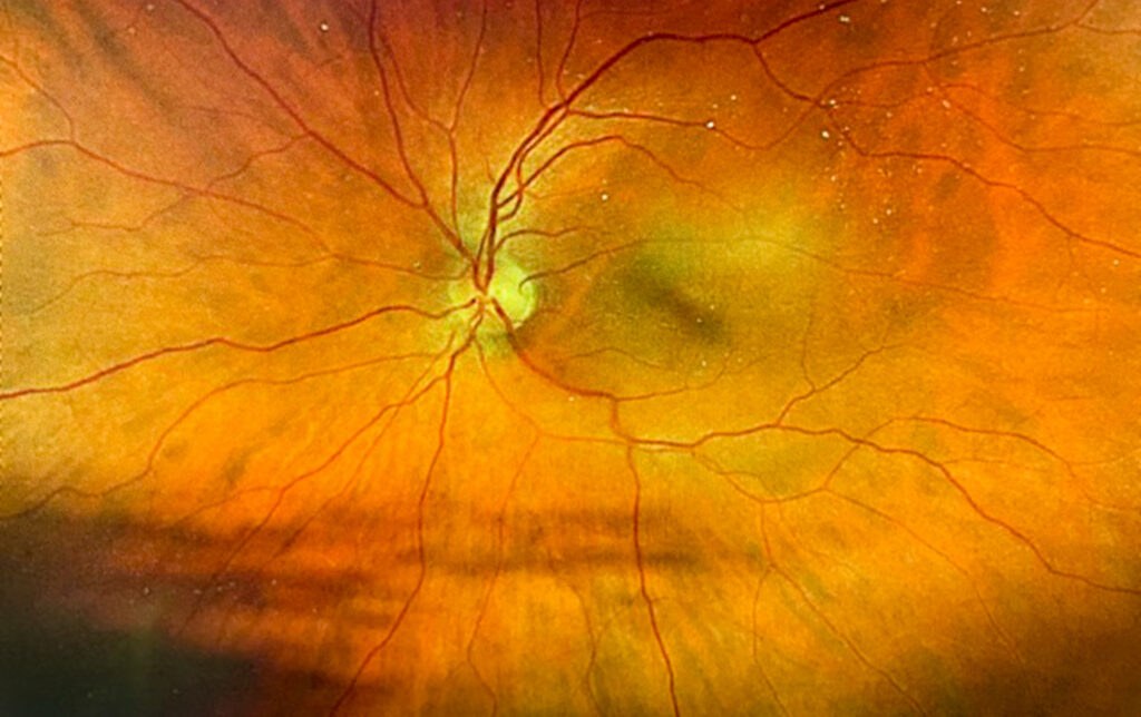 vision-loss-in-diabetic-mice-promoted-by-hypoglycemia,-treated-with-hif-inhibitors