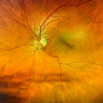 vision-loss-in-diabetic-mice-promoted-by-hypoglycemia,-treated-with-hif-inhibitors