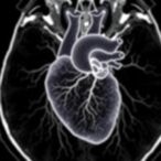 revolutionary-mri-technology-set-to-transform-diagnosis-of-aortic-stenosis