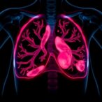 regional-nodal-irradiation-benefits-sln-positive-breast-cancer