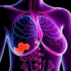 neoadjuvant-parp-timing-in-brca-breast-cancer-trial