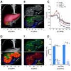 icgr15-predicts-liver-failure-after-hemi-hepatectomy