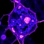 e2f2:-new-therapeutic-target-in-meibomian-carcinoma