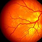 histologic-chorioamnionitis-linked-to-severe-retinopathy