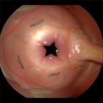 ameloblastoma-insights:-histology-and-treatment-outcomes