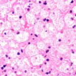 zevra-cashes-in-on-first-fda-approved-npc-treatment-with-prv