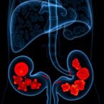 hepatic-lesion-count-predicts-cholangiocarcinoma-outcomes