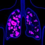foxa2-drives-metastasis-in-small-cell-lung-cancer
