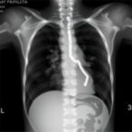 assessing-lung-function-in-congenital-diaphragmatic-hernia