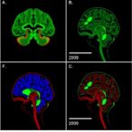gasdermin-e-drives-pyroptosis-resistance-in-glioblastoma