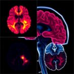 nigral-volume-loss-in-early-parkinson’s-stages