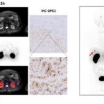 new-immunopet-tracer-boosts-early-liver-cancer-detection