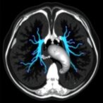 pulmonary-t2*-mri:-new-fetal-lung-assessment-tool?