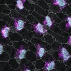 new-insights-into-autism-heart-defect-connection-pave-way-for-early-autism-diagnosis