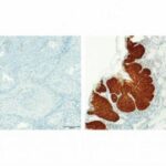 common-oral-bacteria-identified-as-predictive-markers-for-head-and-neck-cancer-progression