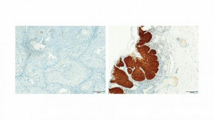 common-oral-bacteria-identified-as-predictive-markers-for-head-and-neck-cancer-progression