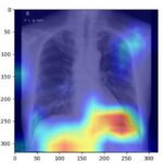 ai-identifies-fatty-liver-disease-using-chest-x-rays