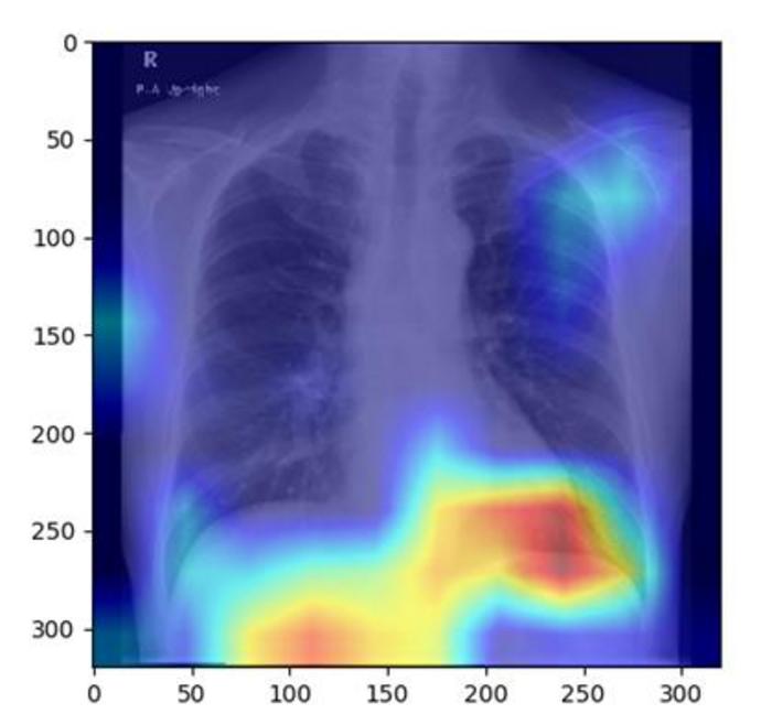 ai-identifies-fatty-liver-disease-using-chest-x-rays