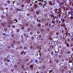 new-study-reveals-strategies-to-reduce-liver-cancer-risk-in-hepatitis-b-patients