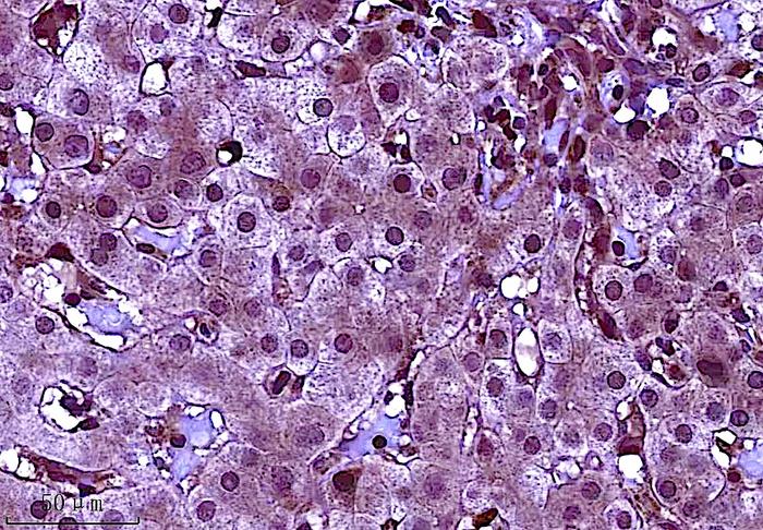 new-study-reveals-strategies-to-reduce-liver-cancer-risk-in-hepatitis-b-patients