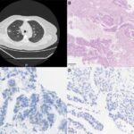 diverse-genetic-profiles-and-treatment-disparities-in-her2-mutated-nsclc-across-brazil