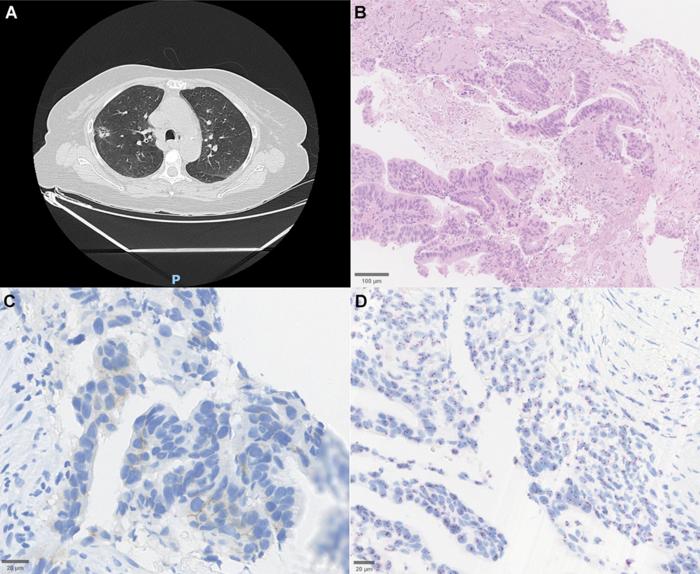 diverse-genetic-profiles-and-treatment-disparities-in-her2-mutated-nsclc-across-brazil