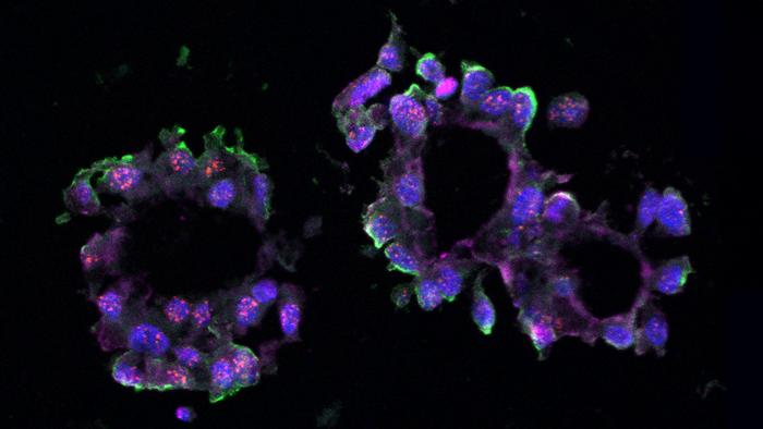 scientists-discover-new-connection-to-triple-negative-breast-cancer