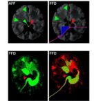 fgfr-inhibition-boosts-glioblastoma-stem-cell-sensitivity