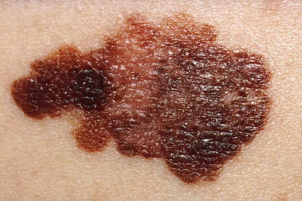 in-a-first,-mitochondrial-mutation-tied-to-melanoma-checkpoint-resistance