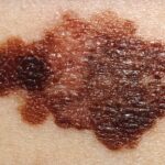in-a-first,-mitochondrial-mutation-tied-to-melanoma-checkpoint-resistance