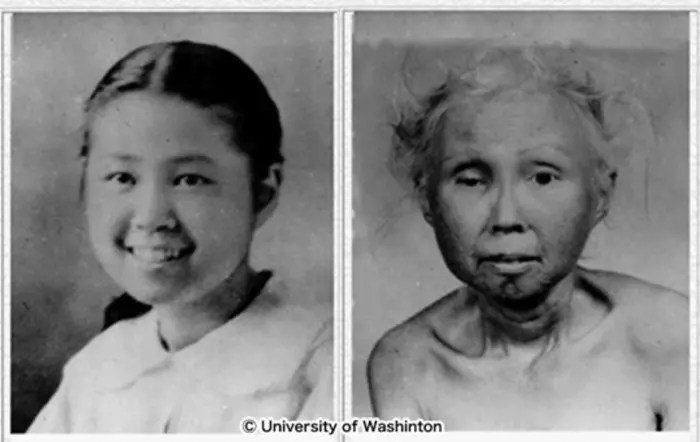 breakthrough-advances-bring-new-hope-to-werner-syndrome-patients