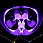 deep-learning-enhances-pet/ct-analysis-in-endometrial-cancer