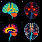 brain-based-clinical-biotypes-in-rem-sleep-disorder