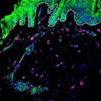 dengue-severity-linked-to-genetic-ancestry’s-influence-on-immune-response