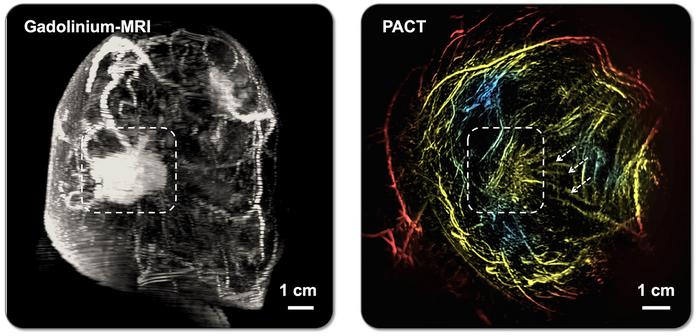 ai-powered-method-provides-safe,-effective,-and-painless-alternative-for-breast-imaging
